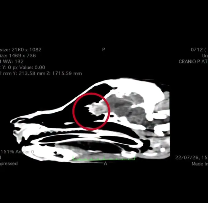 Tomografia mostrando neoplasia cerebral